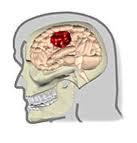 Sorpresas y enfados son factores de riesgo frente a un derrame cerebral